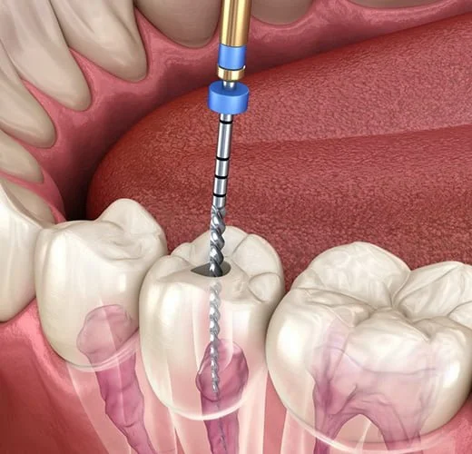 root-canal-treatment